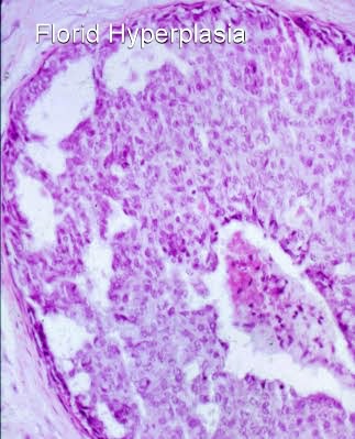 intraductal papilloma with florid ductal hyperplasia)