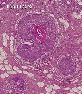 Invasive Lobular Carcinoma and Lobular Carcinoma In-Situ