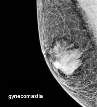 Breast mammogram showed bilateral benign gynecomastia, with the right