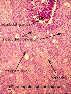 invasive ductal carcinoma histology