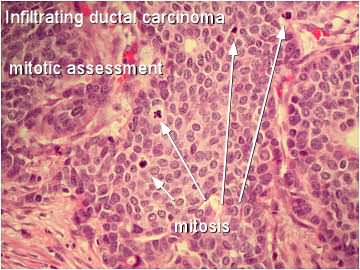 Grades of Invasive Ductal Carcinoma - Moose and Doc