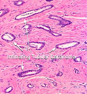 invasive ductal carcinoma histology