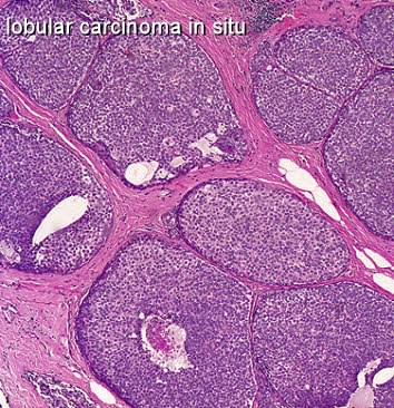 Invasive Lobular Carcinoma and Lobular Carcinoma In-Situ