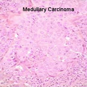 medullary carcinoma