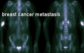 Metastatic Breast Cancer