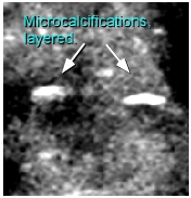 layered microcalcifications