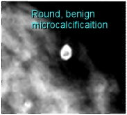 rounded and benign microcalcification