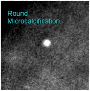 fuzzy edge round microcalcification