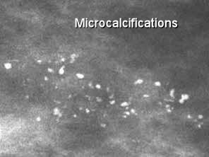 Common Mammogram Findings - Moose and Doc