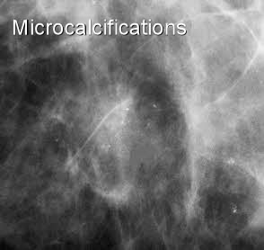 Microcalcifications in Breast Cancer