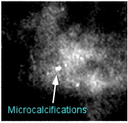 benign microcalcifications