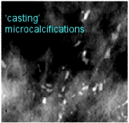 casting linear fragmented BIRADS 5 microcalcifications highly malignant