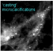 branched granular microcalcifications