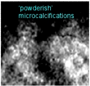 powerderish microcalcifications, BI-RADS 4