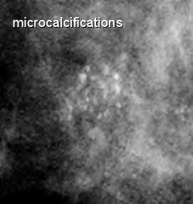 Microcalcifications in Breast Cancer