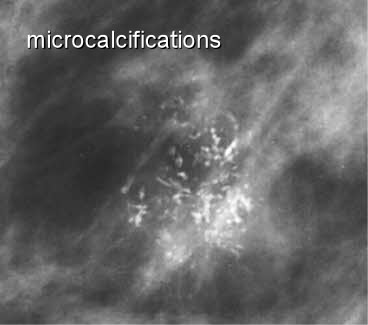 Mammographic microcalcifications and risk of breast cancer