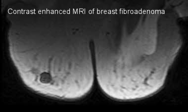 fibrocystic breast changes mri