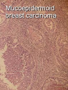 Mucoepidermoid Carcinoma of the breast - Moose and Doc