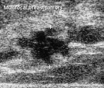 Multicentric Breast Cancer And Multifocal Too Moose And Doc