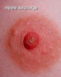 Nipple Discharge