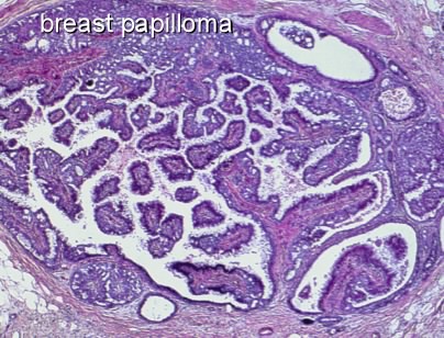 2. Diagnosztikai eljárások - Intraductalis papilloma és dcis