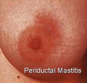 What mastitis looks like: photos