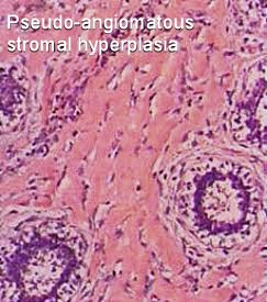 pseudoangiomatous hyperplasia breast Hardcore asian pussy pics