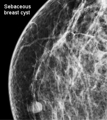 Breast cysts and breast cancer: How can you tell the difference?