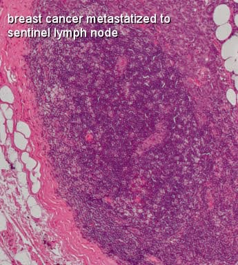 sentinel node biopsy breast cancer