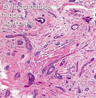 breast cancer adenoma Sluts swallowing cum