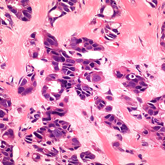 tubular carcinoma