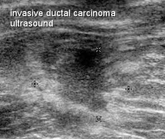 Ultrasound of hypoechoic mass or a solid Breast Lump with Moose and Doc