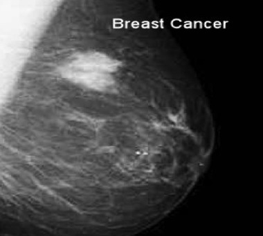 Mammogram - calcifications Information