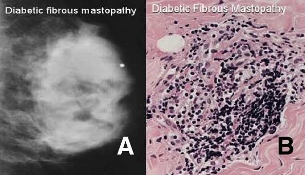 Clinical Pathology: Benign Breast Diseases (Mastitis, Fibrocystic