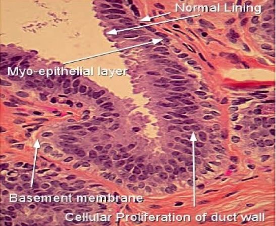 Intraductal papilloma with epithelial hyperplasia. Papilloma ductal hyperplasia