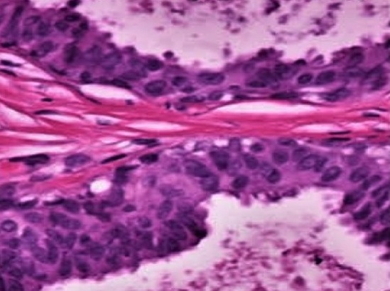 intraductalis papilloma radsokkal 4 hpv nielussa tünet