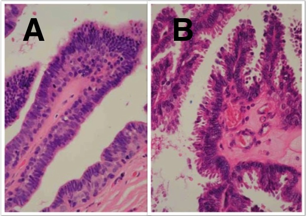 intraductalis papilloma vs csatorna ectasia)