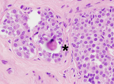 Atypical ductal hyperplasia and lobular hyperplasia with Moose and Doc