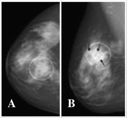 Mixed Type Infiltrating Carcinoma of Breast - DoveMed
