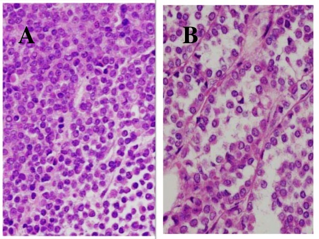 Types of Invasive Lobular Breast Cancer - Moose and Doc