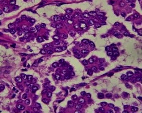 papillary carcinoma