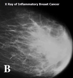 CoppaFeel! on X: Inflammatory breast cancer is a rare type of breast  cancer which may cause the skin on the breast to look red or inflamed. The  symptoms are caused by cancer