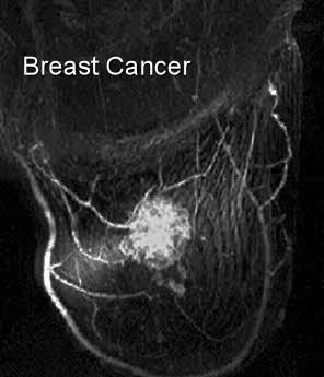 Breast Cancer Metastasis : Survival Rates for Stage IV