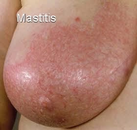 Breast Infection (Mastitis): Symptoms, Causes, Treatments