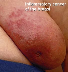 What does an early inflammatory breast cancer rash look like?