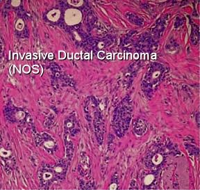 Ductal Carcinoma In Situ Dcis Dr Susan Love Foundation For Breast Cancer Research